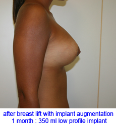 plastic-surgery-breast-lift-augmentation